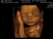 >INSIGHT 4D ULTRASOUND