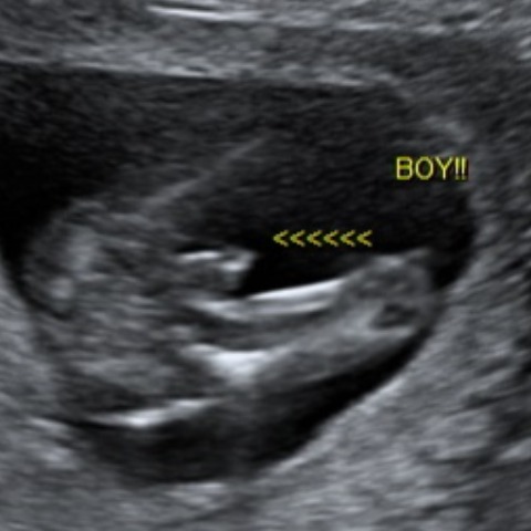12 week 3d ultrasound gender